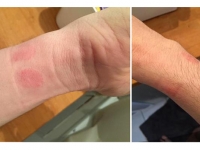 想買Apple Watch？小心皮膚過(guò)敏發(fā)紅！